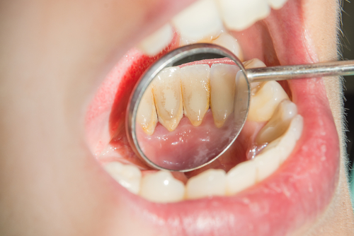 Comment éliminer la plaque dentaire en 5 minutes ? – MyVariations